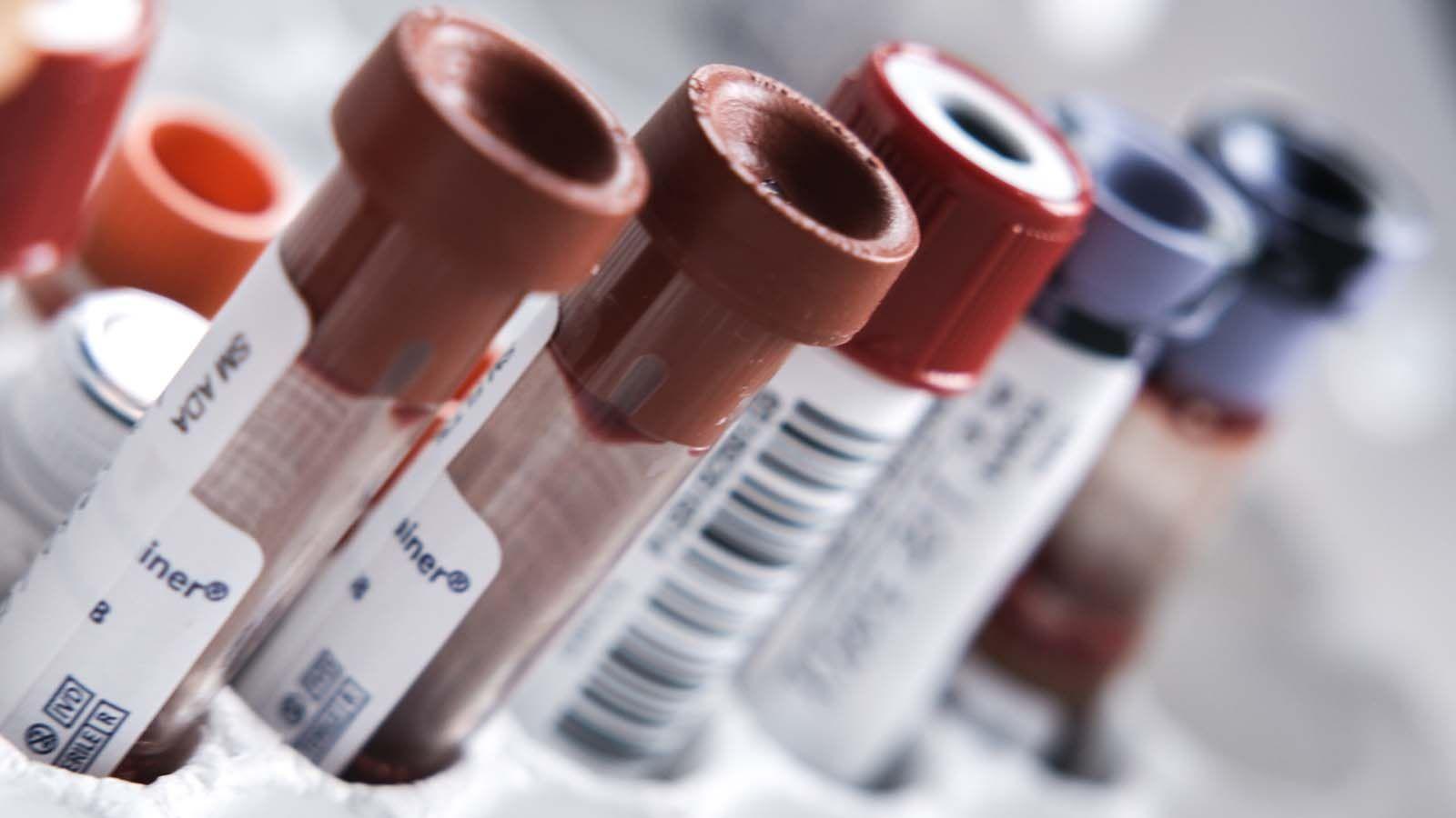 Row of blood samples in vials